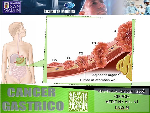 cancer gastrico